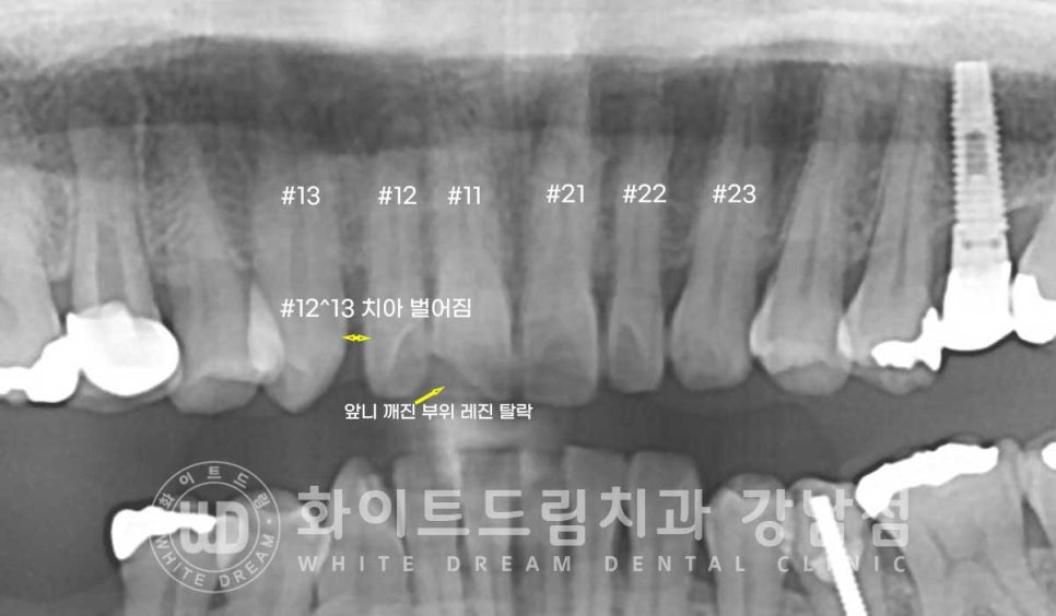 앞니 원데이라미네이트 / 떨어진 앞니 레진 & 벌어진 앞니, 라미네이트로 당일 개선 ★ 관련 이미지 5