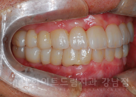 서울 전체임플란트 기간 / 전체 임플란트 7개월 완성, 무치악 임플란트 관련 이미지 14
