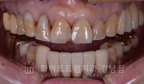 중년 앞니라미네이트 / 노화로 마모되고 누렇게 변한 치아, 어떻게 치료할까? 관련 이미지 16