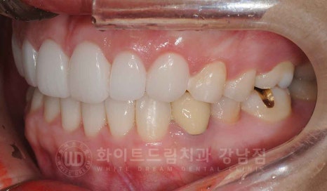 강남역 나비앞니 라미네이트 / "투명교정과 라미네이트 치료" 강남역 화이트드림치과 관련 이미지 8