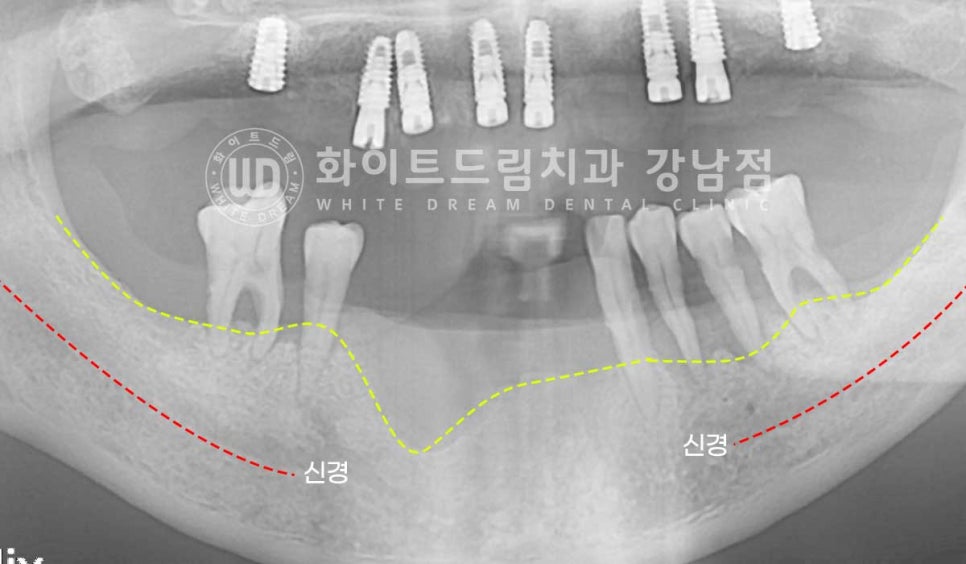 치주염 전체임플란트, 염증으로 인한 상악동 천공 & 신경관 가까이 녹은 잇몸뼈. 임플란트 식립 가능할까? 관련 이미지 12