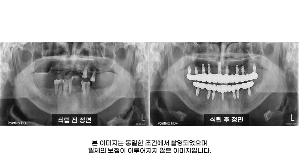 어금니임플란트 수복 및 당뇨환자임플란트 가격, 종류, 통증 관련 이미지 23