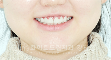 강남역 원데이 라미네이트 "유튜브 촬영하는데 치아가 신경 쓰여요" #강남화이트드림치과 관련 이미지 3