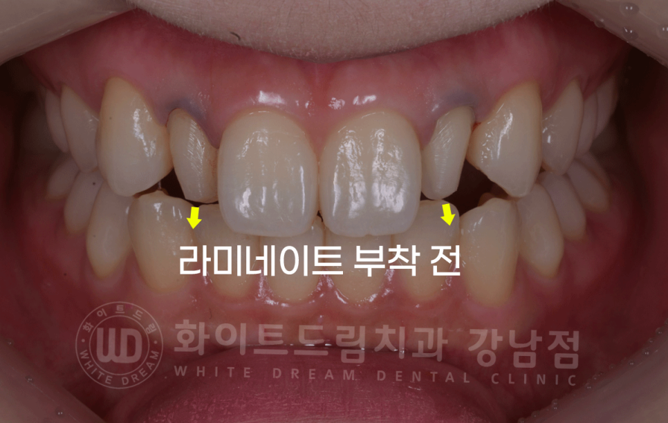 강남역 심미치과 "치아 하나가 유난히 작아요" #왜소치라미네이트 관련 이미지 6