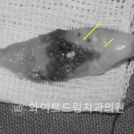 강남역전체임플란트 / 발치 후 즉시 식립, 무조건 누구나 3개월로 끝낼 수 있는 것일까? 강남역화이트드림치과 관련 이미지 10