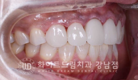 깨진앞니 라미네이트 / 깨지고 누렇게 변한 앞니는? 원데이 라미네이트 치료 사례 관련 이미지 13