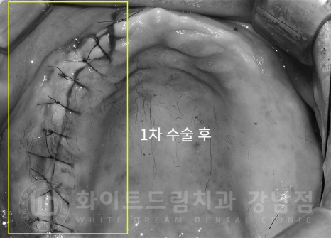 서울 전체임플란트 기간 / 전체 임플란트 7개월 완성, 무치악 임플란트 관련 이미지 8