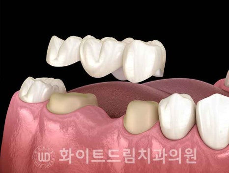 서울전체임플란트잘하는치과, 왜 치주염이 심해지면 반대교합까지 생길까요? (치주염 전체 임플란트 CASE) 관련 이미지 11