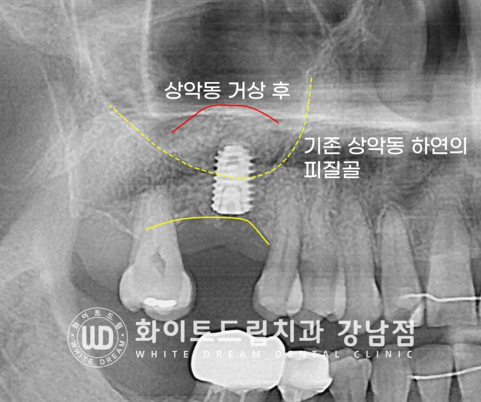 상악 어금니 임플란트 치료 시 동반되는 "상악동 거상술" 이란? 관련 이미지 5