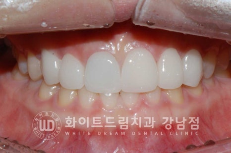 벌어진 앞니라미네이트 / "왜소치로 치아가 벌어졌어요" 치료 사례 관련 이미지 13