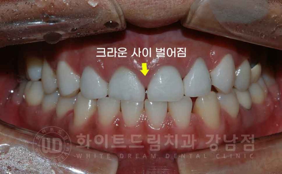 역삼역 앞니 치료  "예전에 한 크라운, 라미네이트 바꾸고 싶어요" 라미네이트 & 크라운 재치료 관련 이미지 7