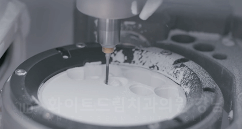 강남역 임플란트 치과 "틀니가 안 맞아서 불편해요" 틀니 → 전체 임플란트로! 관련 이미지 18