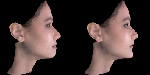 치아교정, 꼭 해야 한다면 미리 알아 두자. 관련 이미지 31