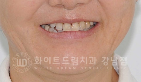 노화된 치아 라미네이트 / 치아미백을 해도 하얘지지 않는 마모된 치아는 어떻게 할까? 관련 이미지 5