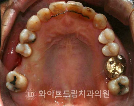 강남역어금니임플란트 치료 시 흔히 동반되는 상악동거상술 (Lateral window 방식), "잘 됐는지 어떻게 확인하죠?" 관련 이미지 2