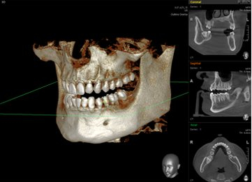 치아교정, 꼭 해야 한다면 미리 알아 두자. 관련 이미지 27