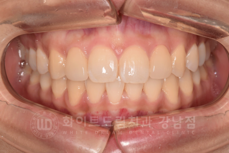 신논현역 라미네이트 / 과개교합 치아교정 + 왜소치 라미네이트 진행 case 관련 이미지 18