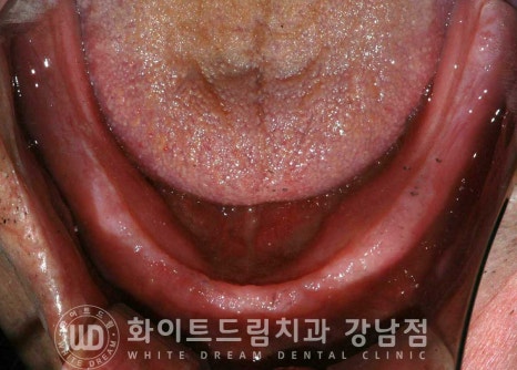 전체 임플란트 치료 기간과 수술 후 나타나는 변화는? 관련 이미지 16