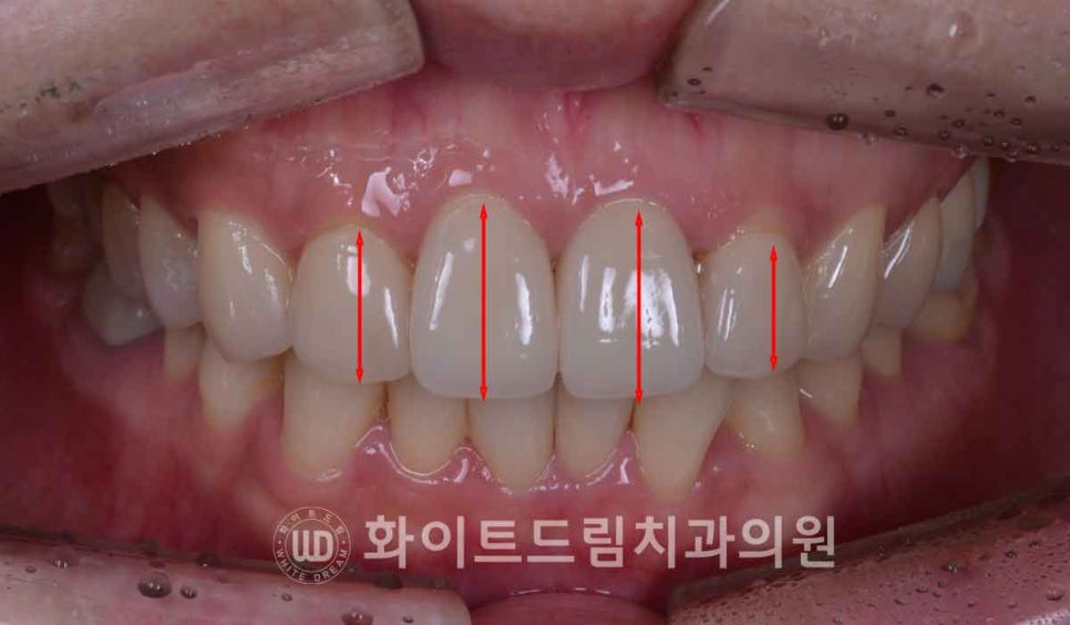 뱅뱅사거리치과 "라미네이트가 마음에 들지 않아요. 하얗고 균일한 치아를 갖고 싶어요." 강남역 화이트드림치과 관련 이미지 4