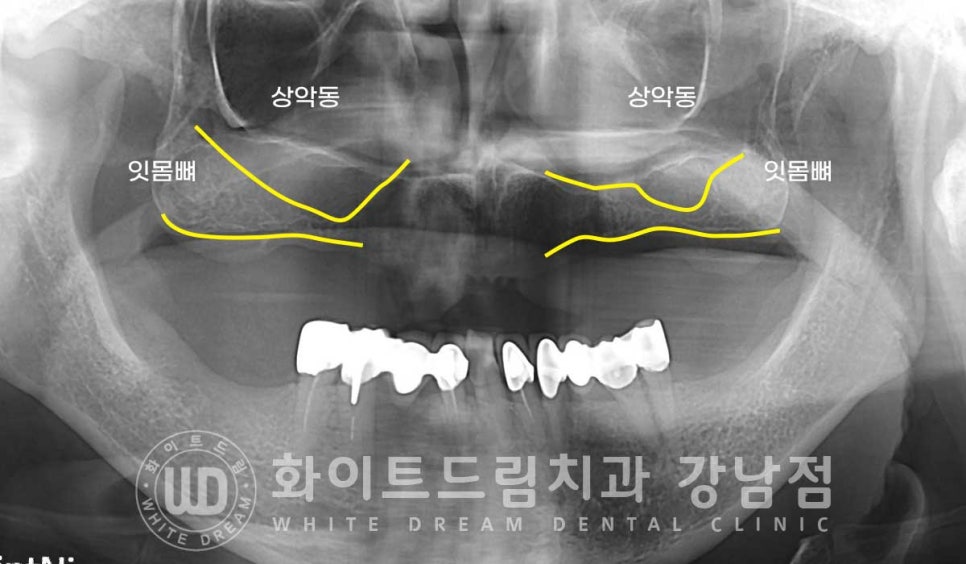 상악 풀케이스임플란트 사례 "부산에서 강남까지 왔어요" 관련 이미지 6