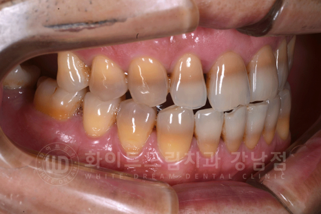 강남역 인근 치과 / 테트라사이클린(tetracycline) 치아 변색 / 라미네이트로 개선! 관련 이미지 9