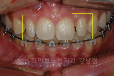 신논현역 라미네이트 / 과개교합 치아교정 + 왜소치 라미네이트 진행 case 관련 이미지 11