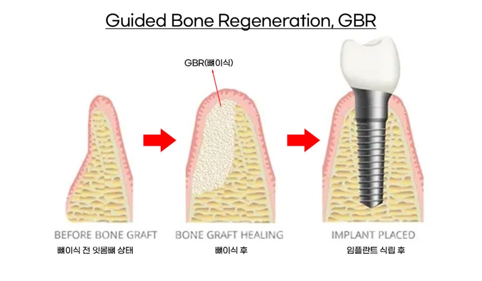 40대 전체임플란트 / 디지털스캔바디를 이용한 전체 임플란트 치료 사례 (Feat. 치주염) 관련 이미지 13