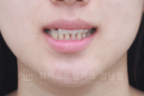 강남 덧니 비발치교정 / 임플란트와 치아교정 동시 진행 case 리뷰. 관련 이미지 2