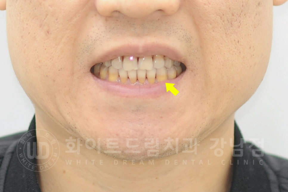 강남역 인근 치과 / 테트라사이클린(tetracycline) 치아 변색 / 라미네이트로 개선! 관련 이미지 5