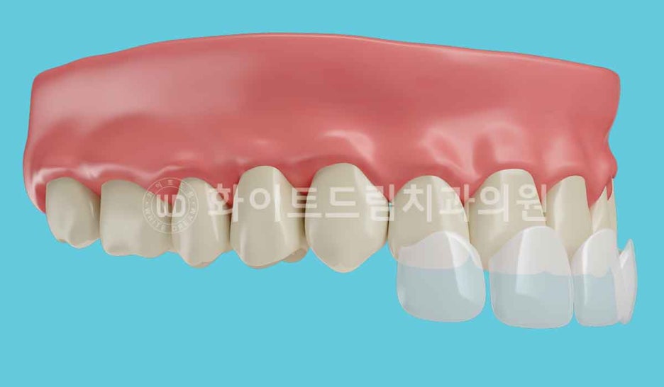 뱅뱅사거리치과 "라미네이트가 마음에 들지 않아요. 하얗고 균일한 치아를 갖고 싶어요." 강남역 화이트드림치과 관련 이미지 3