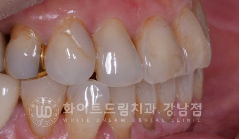 노화된 치아 라미네이트 / 치아미백을 해도 하얘지지 않는 마모된 치아는 어떻게 할까? 관련 이미지 11