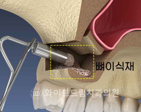 강남역어금니임플란트 치료 시 흔히 동반되는 상악동거상술 (Lateral window 방식), "잘 됐는지 어떻게 확인하죠?" 관련 이미지 10