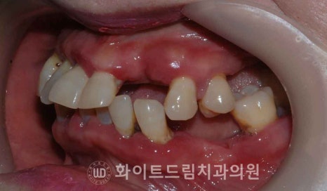 서울전체임플란트 / "경상도에서 왔어요." 치주염으로 인한 앞니 돌출 치료 (+서울전체임플란트 내원 횟수는?) 관련 이미지 15