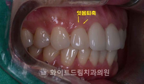 뱅뱅사거리치과 "라미네이트가 마음에 들지 않아요. 하얗고 균일한 치아를 갖고 싶어요." 강남역 화이트드림치과 관련 이미지 6