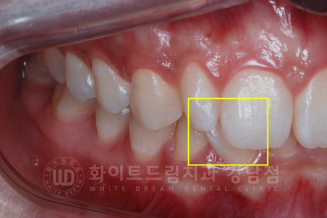 신논현역 라미네이트 / 과개교합 치아교정 + 왜소치 라미네이트 진행 case 관련 이미지 5