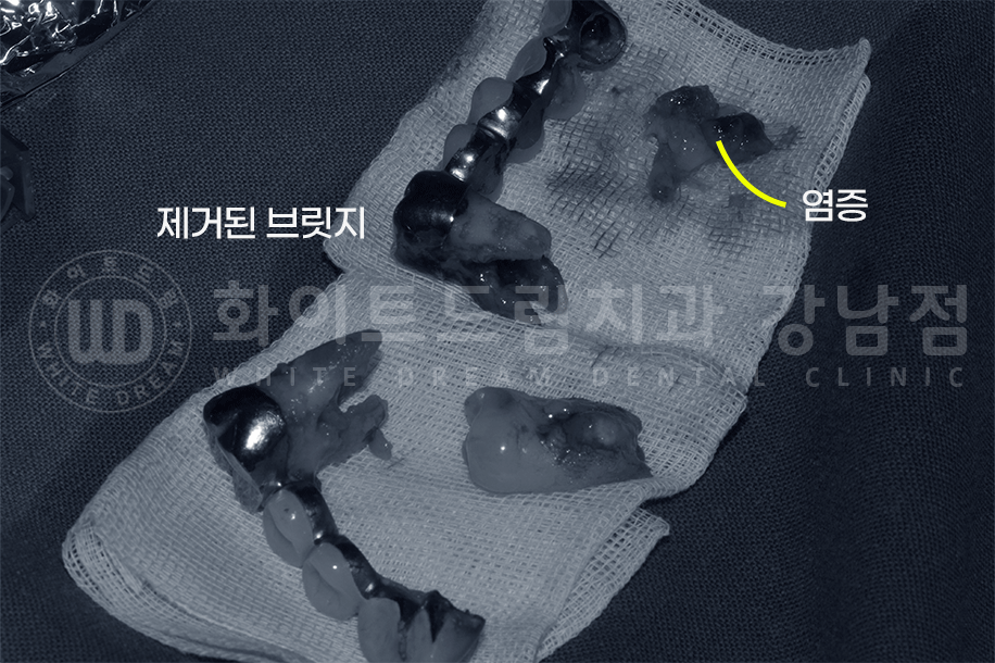 강남역 치과브릿지 "브릿지가 흔들려요" 흔들리는 브릿지 치료는? 관련 이미지 6
