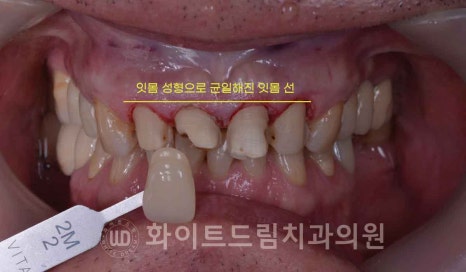 신논현역 당일 라미네이트, "길이가 다른 깨진 앞니" 당일 앞니 라미네이트 치료 과정은? 관련 이미지 11