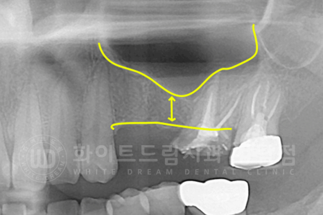 강남역 어금니 임플란트 "어금니가 부러졌어요" 상악동 거상술(lateral approach) 관련 이미지 11