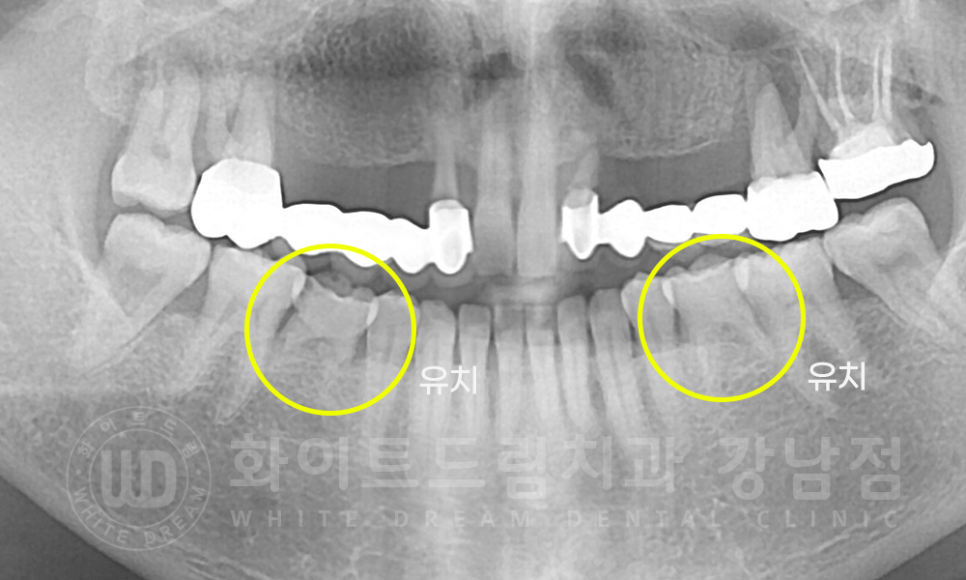 강남역 치과브릿지 "브릿지가 흔들려요" 흔들리는 브릿지 치료는? 관련 이미지 4