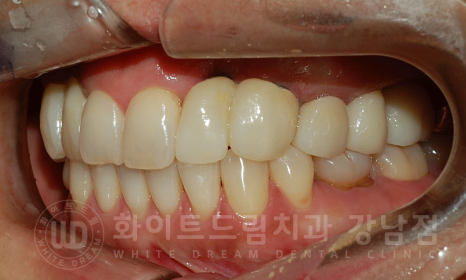 강남역 치과브릿지 "브릿지가 흔들려요" 흔들리는 브릿지 치료는? 관련 이미지 14