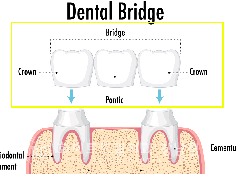 강남역 치과브릿지 "브릿지가 흔들려요" 흔들리는 브릿지 치료는? 관련 이미지 2