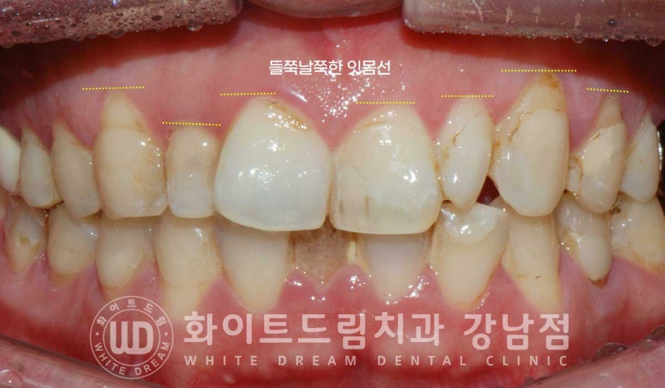 앞니 레진변색 "너무 지저분해 보여요." 라미네이트로 깔끔하게 교체한 치료 사례 관련 이미지 12