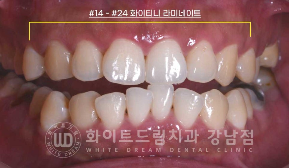 틀어진 치아 라미네이트, 틀어지고 색이 다른 앞니가 고민이에요. 관련 이미지 7