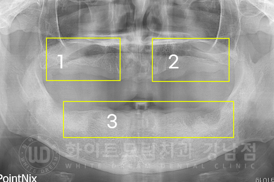 강남역 전체임플란트 치과 "치아가 심하게 흔들려요." 심한 치주염 임플란트 치료 관련 이미지 6