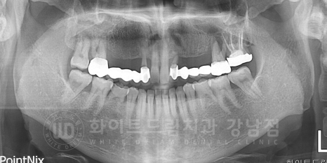 강남역 치과브릿지 "브릿지가 흔들려요" 흔들리는 브릿지 치료는? 관련 이미지 11