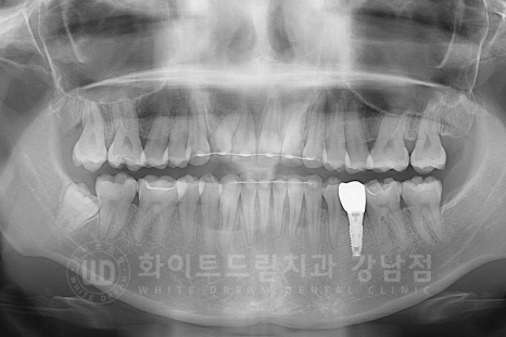 강남 덧니 비발치교정 / 임플란트와 치아교정 동시 진행 case 리뷰. 관련 이미지 15