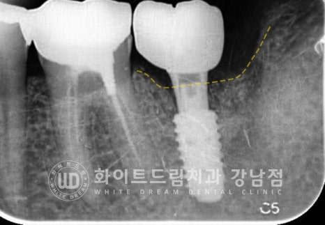 강남역 임플란트재수술 치과 / "임플란트가 흔들려요!" 임플란트 주위염 관련 이미지 11