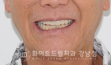 상악 풀케이스임플란트 사례 / "지인 추천으로 인천에서 왔어요." 관련 이미지 3