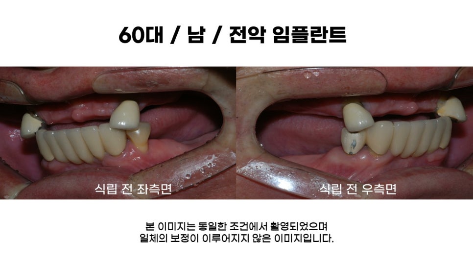 60대 전악임플란트후기 및 치료기간 관련 이미지 2