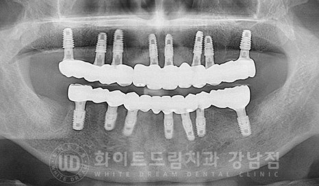 전체 임플란트 치료 기간과 내원 횟수는? "치과에 자주 가기 어려워요." 관련 이미지 5